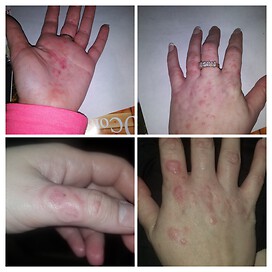 A couple of the rashes I have experienced on my hands