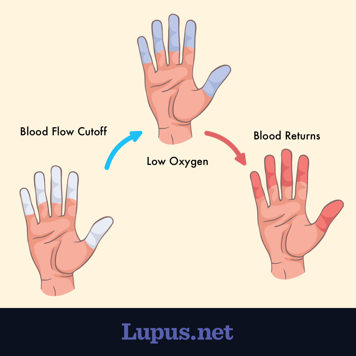 How are Raynaud's and Lupus Related?