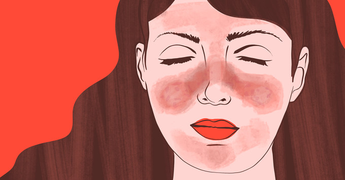 I Am Not Blushing – It Is My Malar Rash image