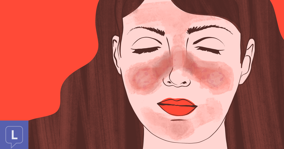What Is A Lupus Malar Butterfly Rash And How Do I Deal With It