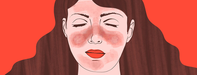 I Am Not Blushing – It Is My Malar Rash image