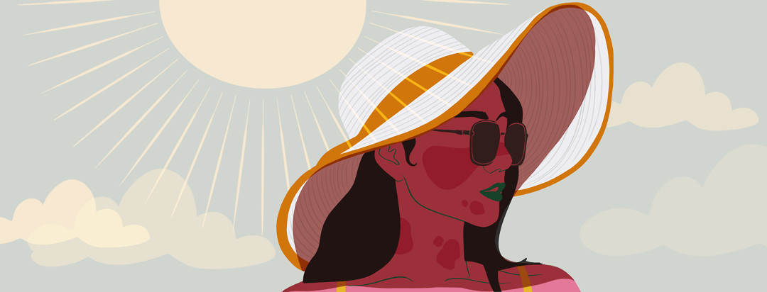 A woman with discoid lupus wearing sunglasses and a large brimmed sun hat shield herself from the damaging sun rays.