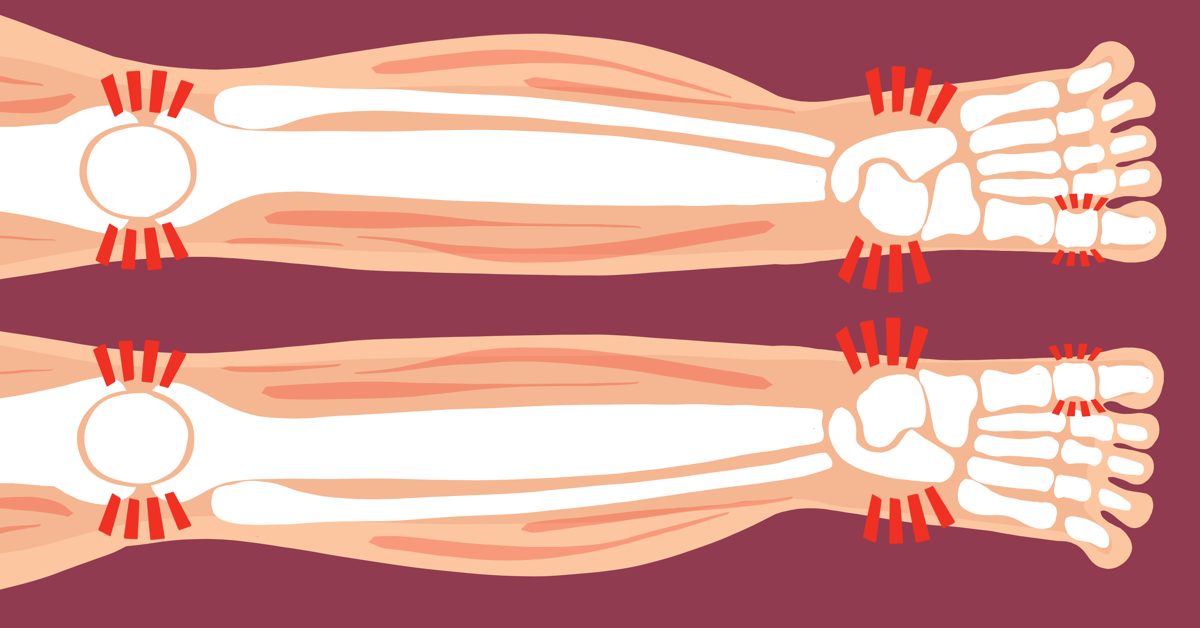 Brittle Bones With Lupus Feeling Like Bone on Bone