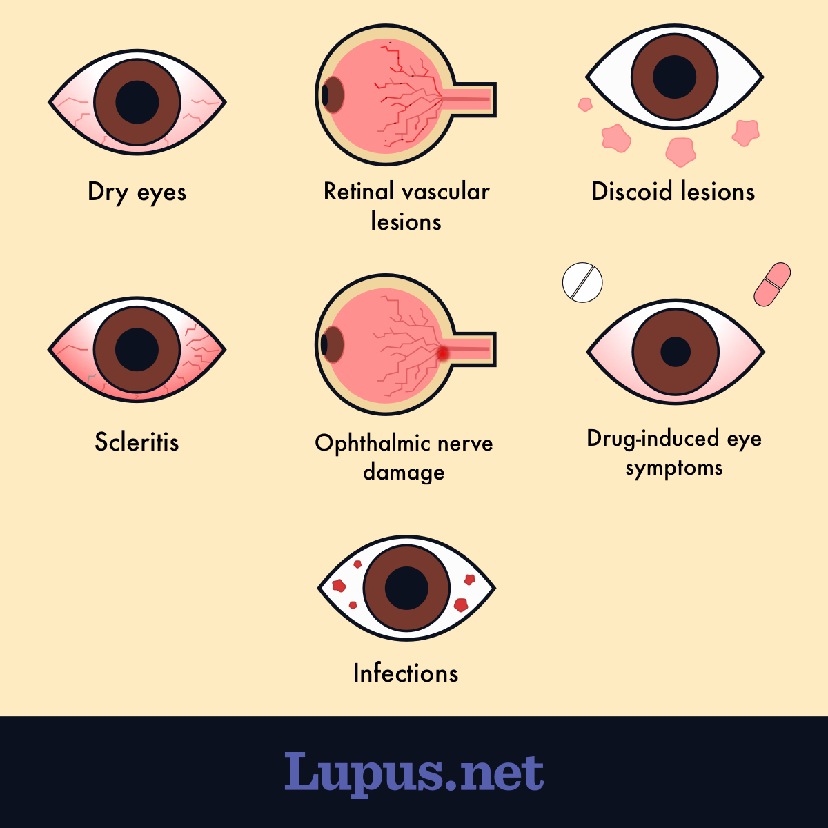 An illustration of the eye complications of lupus, including dry eye, discoid lesions, scleritis, ophthalmic nerve damage, drug-induced eye symptoms, and infections.