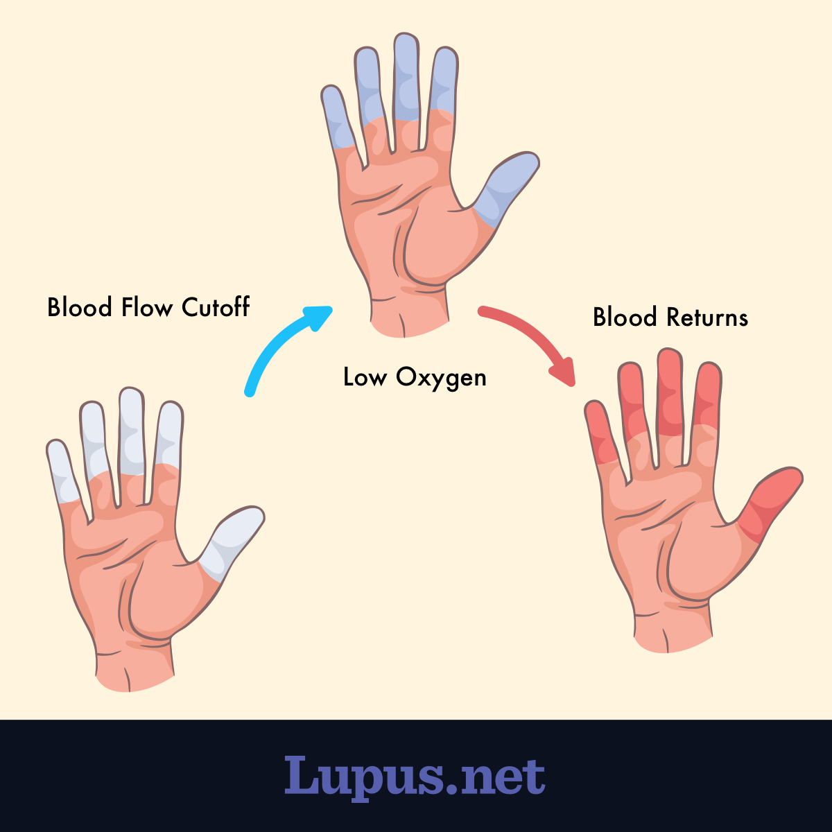 three hands showing the progression of Raynaud's syndrome, showing blood flow cutoff, low oxygen, and blood returning