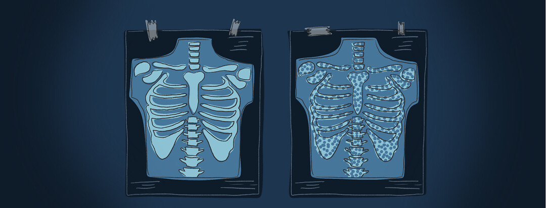 Two chest/back xrays are shown - one showing holes from osteoporosis, the other is healthy.