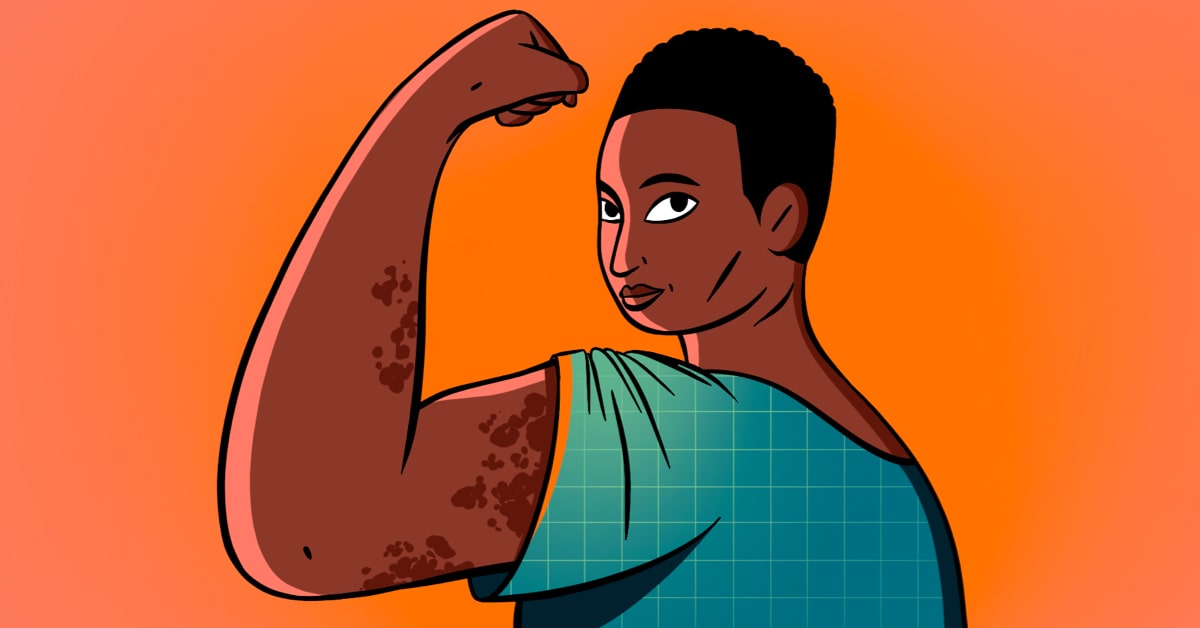 Lupus Is Not Stopping Me From Living My Life